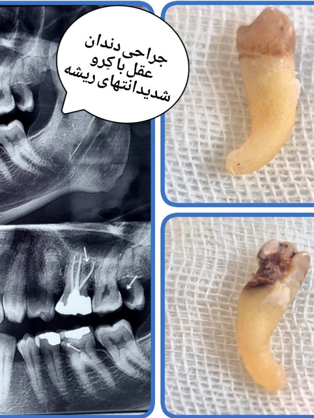 نمونه کار جراحی عقل