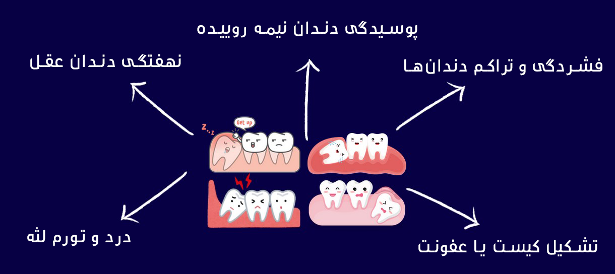 جراحی دندان عقل: هر آنچه باید بدانید