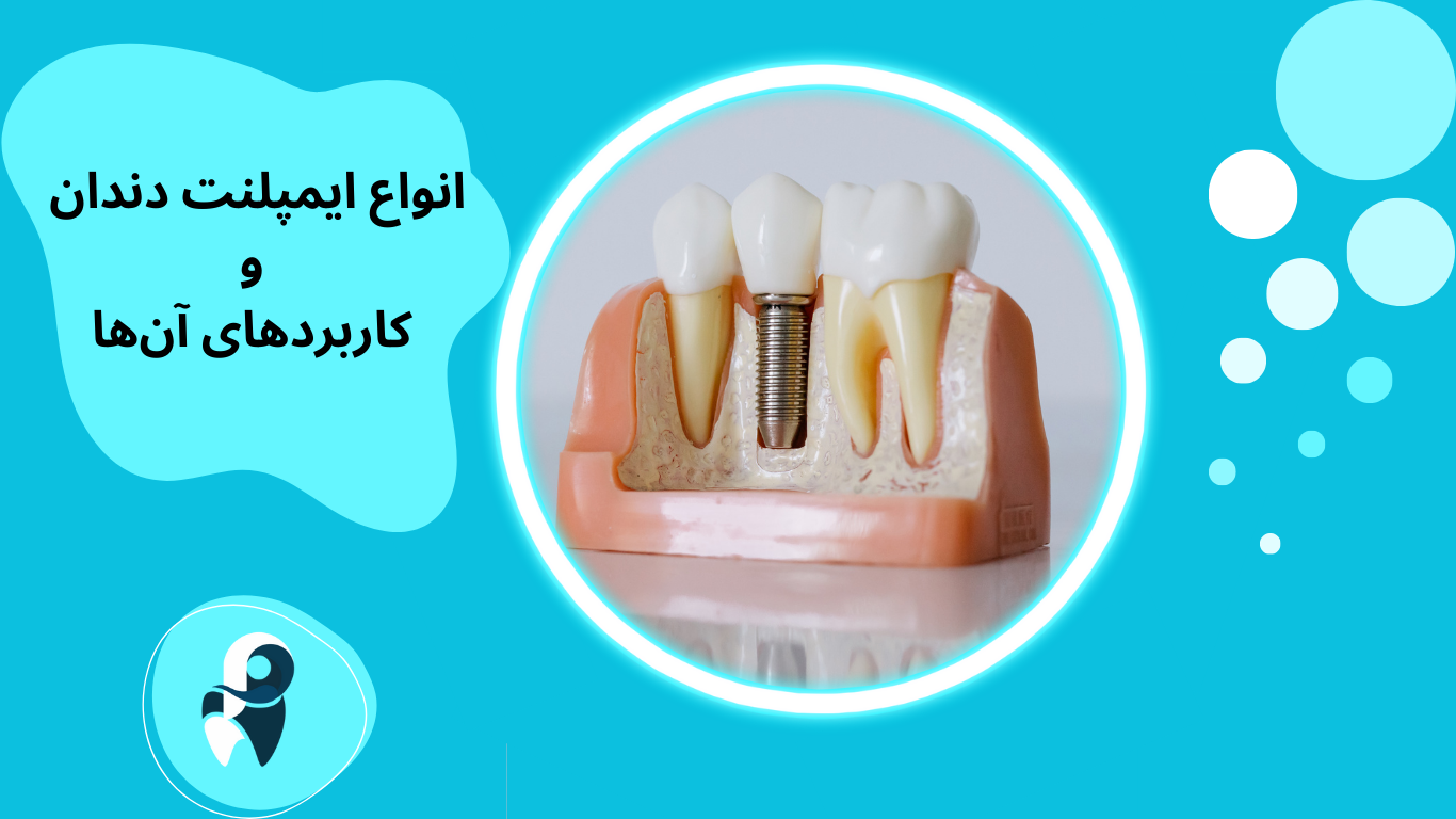 انواع ایمپلنت دندان و کاربردهای آن‌ها